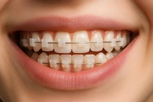  Керамические брекеты: эстетика и эффективность в ортодонтии