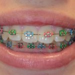 Correcting a bite with braces