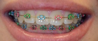 Correcting a bite with braces